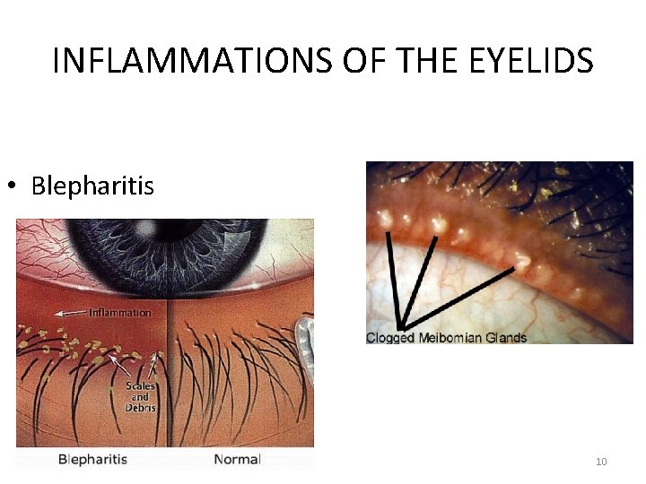 INFLAMMATIONS OF THE EYELIDS • Blepharitis 10 