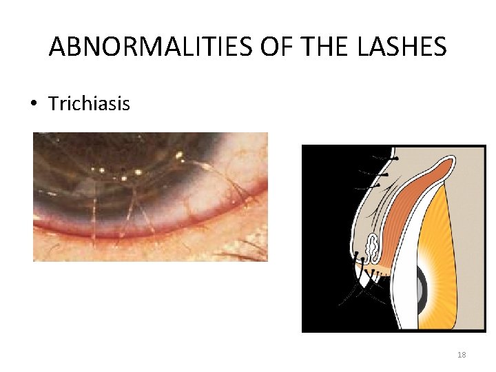 ABNORMALITIES OF THE LASHES • Trichiasis 18 