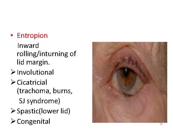  • Entropion Inward rolling/inturning of lid margin. Ø Involutional Ø Cicatricial (trachoma, burns,