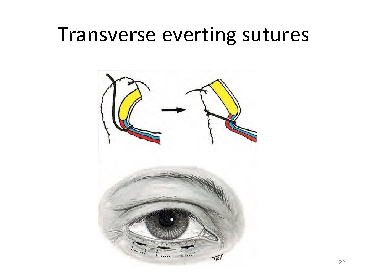 Transverse everting sutures 22 