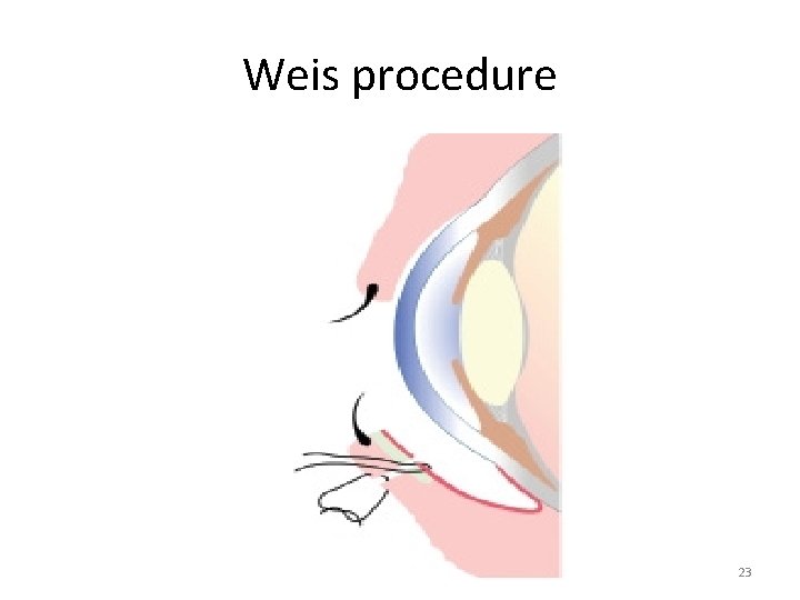 Weis procedure 23 