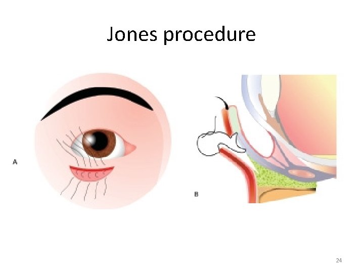 Jones procedure 24 