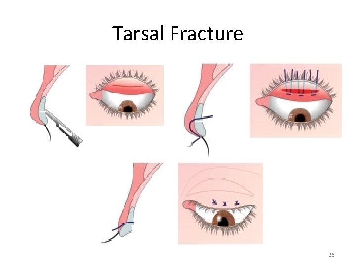 Tarsal Fracture 26 