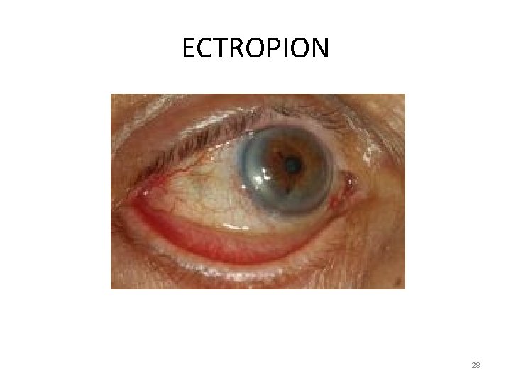 ECTROPION 28 