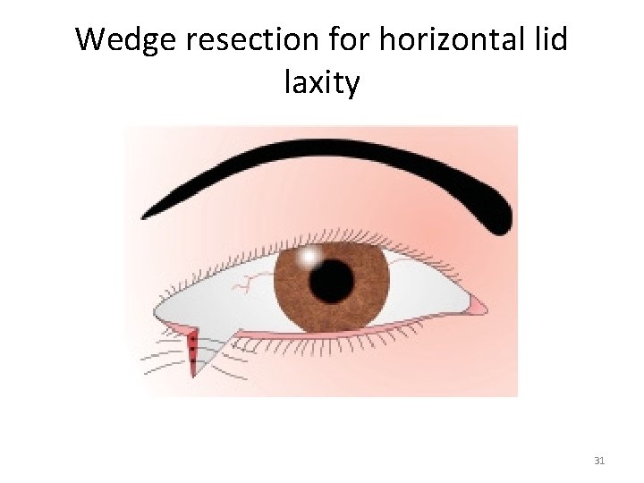 Wedge resection for horizontal lid laxity 31 