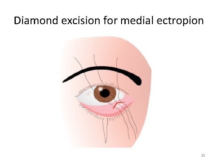 Diamond excision for medial ectropion 32 