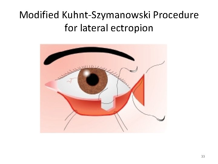 Modified Kuhnt-Szymanowski Procedure for lateral ectropion 33 