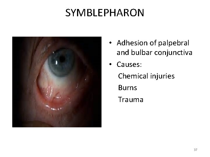 SYMBLEPHARON • Adhesion of palpebral and bulbar conjunctiva • Causes: Chemical injuries Burns Trauma