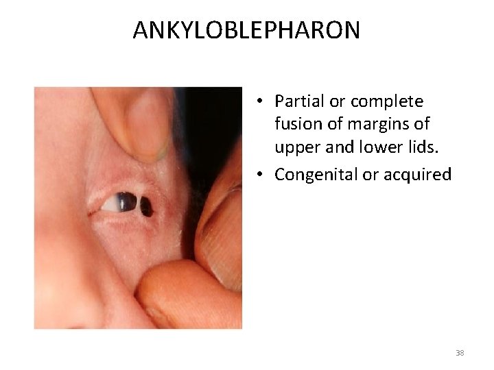 ANKYLOBLEPHARON • Partial or complete fusion of margins of upper and lower lids. •