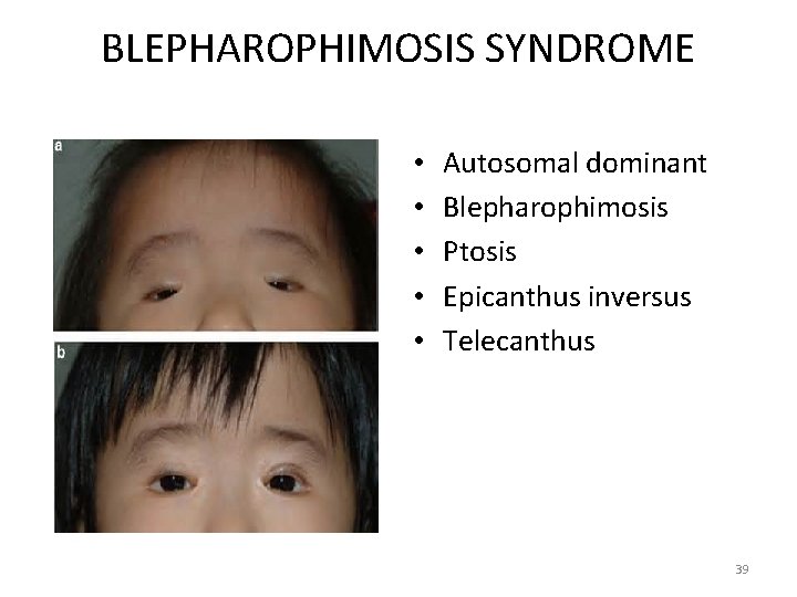 BLEPHAROPHIMOSIS SYNDROME • • • Autosomal dominant Blepharophimosis Ptosis Epicanthus inversus Telecanthus 39 