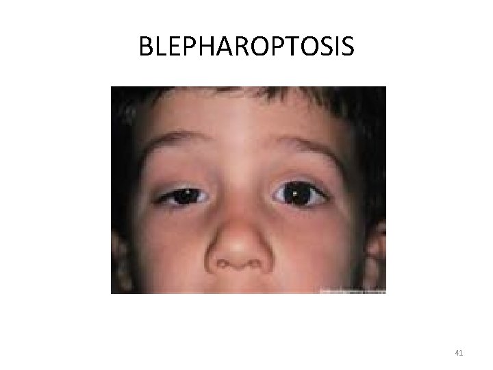 BLEPHAROPTOSIS 41 