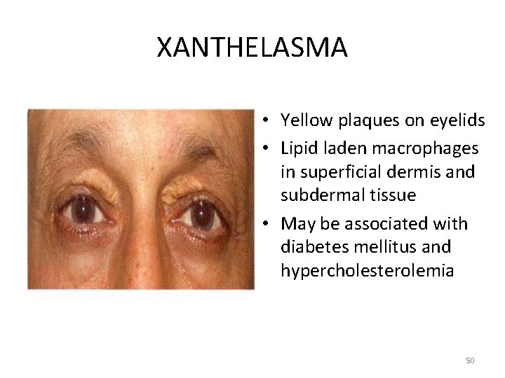 XANTHELASMA • Yellow plaques on eyelids • Lipid laden macrophages in superficial dermis and