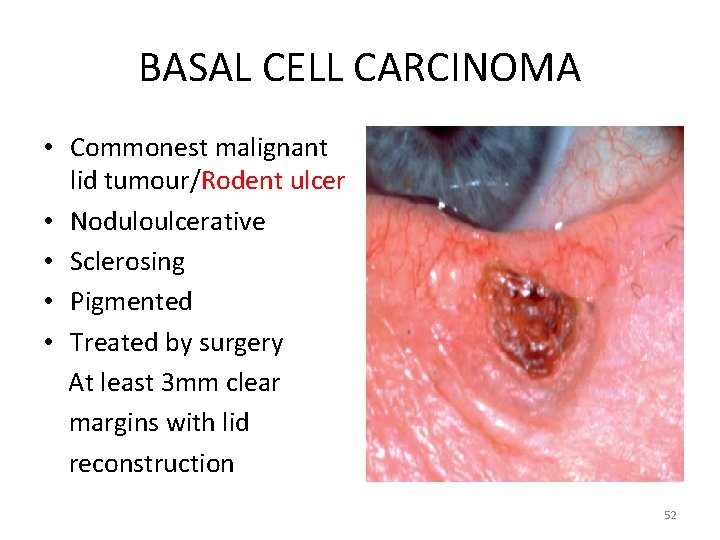 BASAL CELL CARCINOMA • Commonest malignant lid tumour/Rodent ulcer • Noduloulcerative • Sclerosing •