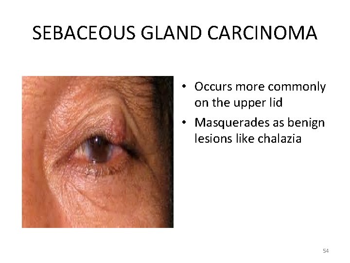 SEBACEOUS GLAND CARCINOMA • Occurs more commonly on the upper lid • Masquerades as