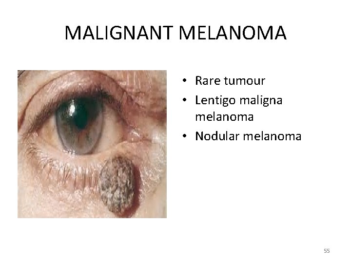 MALIGNANT MELANOMA • Rare tumour • Lentigo maligna melanoma • Nodular melanoma 55 