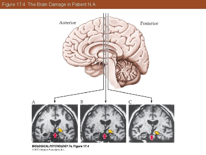 Figure 17. 4 The Brain Damage in Patient N. A. Figure 17. 4 The Brain Damage in Patient N. A.