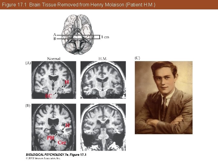 Figure 17. 1 Brain Tissue Removed from Henry Molaison (Patient H. M. ) Figure 17. 1 Brain Tissue Removed from Henry Molaison (Patient H. M. )