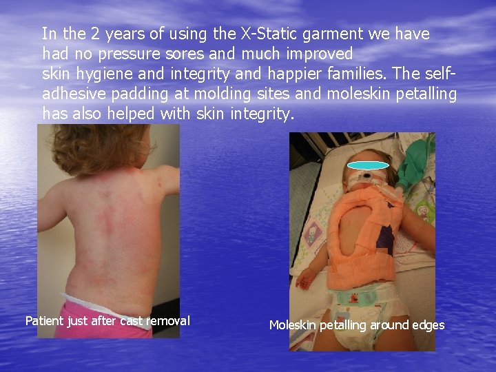 In the 2 years of using the X-Static garment we have had no pressure