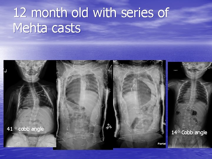 12 month old with series of Mehta casts 41 ° cobb angle 14° Cobb