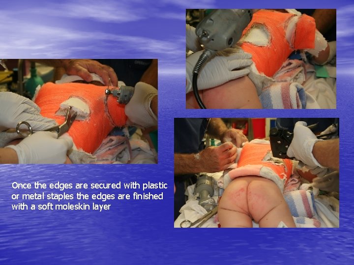 Once the edges are secured with plastic or metal staples the edges are finished