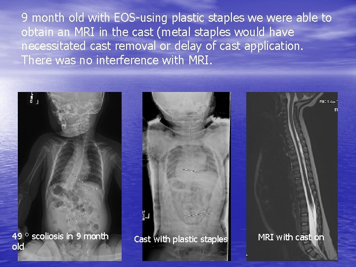 9 month old with EOS-using plastic staples we were able to obtain an MRI