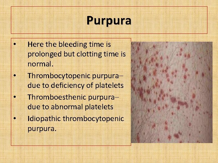 Purpura • • Here the bleeding time is prolonged but clotting time is normal.