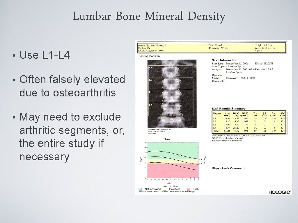 Lumbar Bone Mineral Density • Use L 1 -L 4 • Often falsely elevated