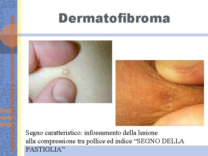 Dermatofibroma Segno caratteristico: infossamento della lesione alla compressione tra pollice ed indice “SEGNO DELLA