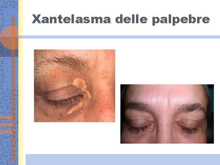 Xantelasma delle palpebre 