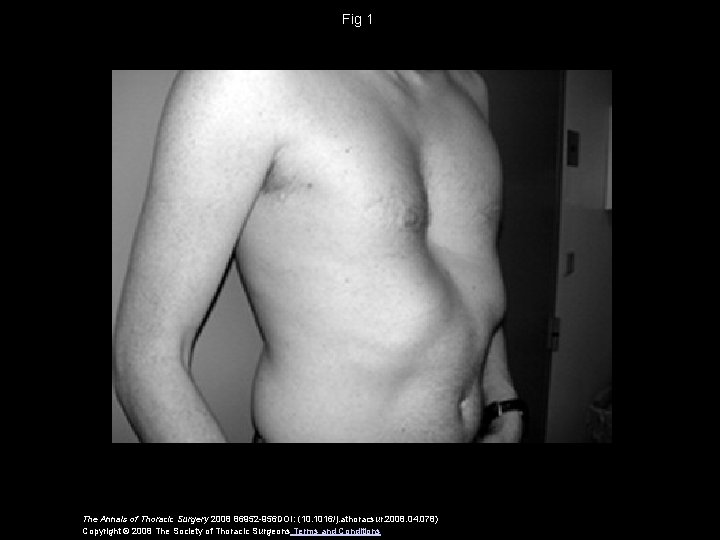 Fig 1 The Annals of Thoracic Surgery 2008 86952 -956 DOI: (10. 1016/j. athoracsur.
