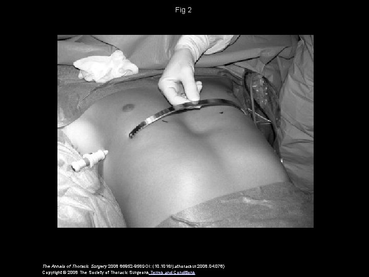 Fig 2 The Annals of Thoracic Surgery 2008 86952 -956 DOI: (10. 1016/j. athoracsur.