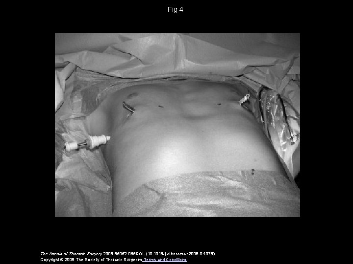 Fig 4 The Annals of Thoracic Surgery 2008 86952 -956 DOI: (10. 1016/j. athoracsur.