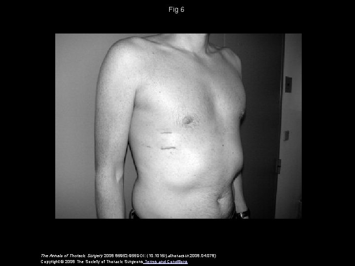Fig 6 The Annals of Thoracic Surgery 2008 86952 -956 DOI: (10. 1016/j. athoracsur.