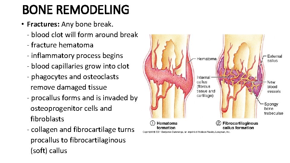 BONE REMODELING • Fractures: Any bone break. - blood clot will form around break