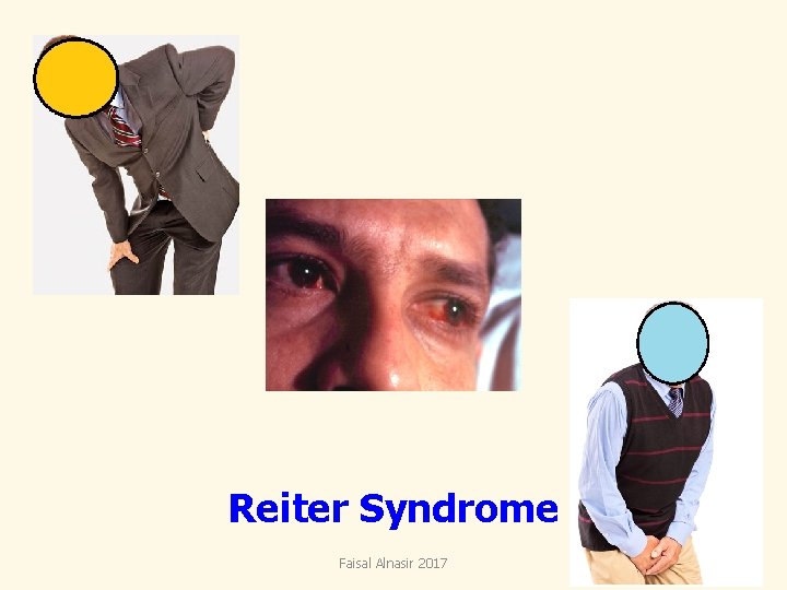 Reiter Syndrome Faisal Alnasir 2017 17 Reiter Syndrome Faisal Alnasir 2017 17
