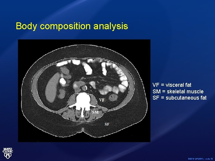 Body Composition Changes at Computed Tomography After Left