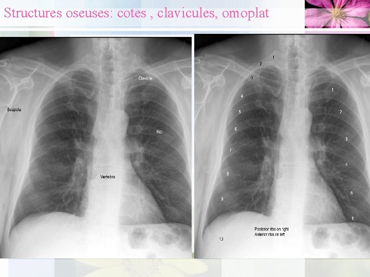 Structures oseuses: cotes , clavicules, omoplat 