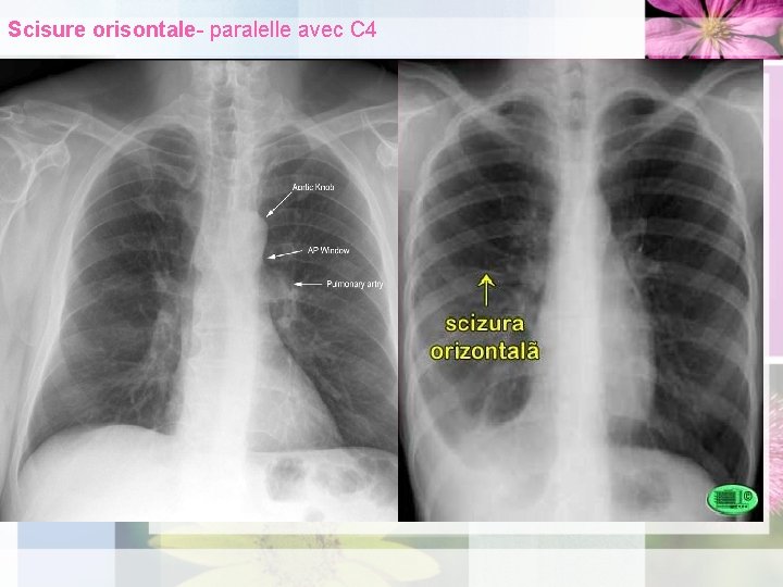 Scisure orisontale- paralelle avec C 4 