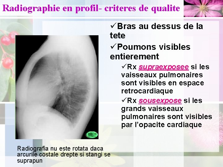 Radiographie en profil- criteres de qualite üBras au dessus de la tete üPoumons visibles