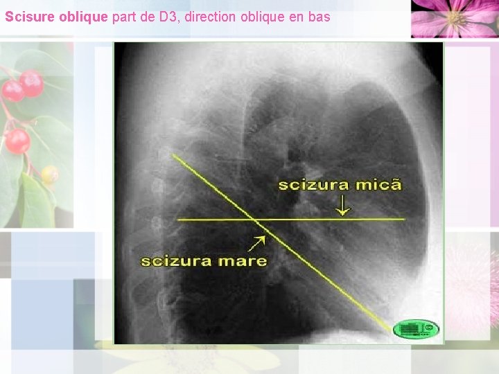 Scisure oblique part de D 3, direction oblique en bas 