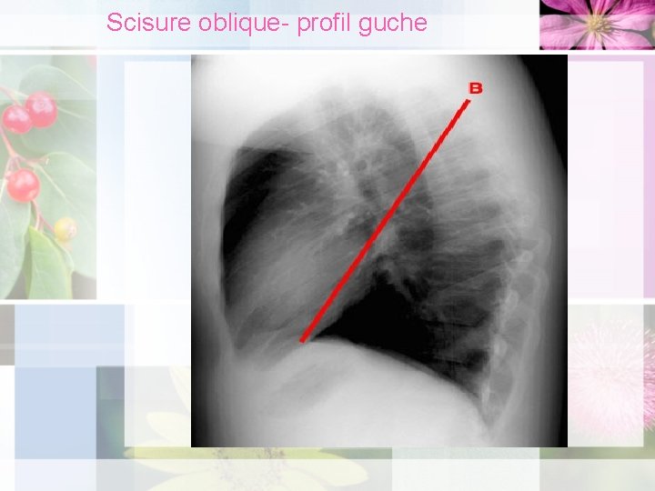 Scisure oblique- profil guche 