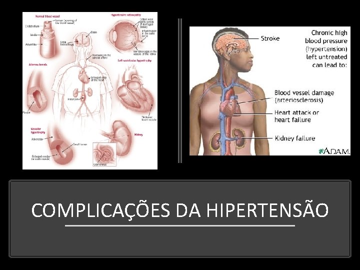 COMPLICAÇÕES DA HIPERTENSÃO 