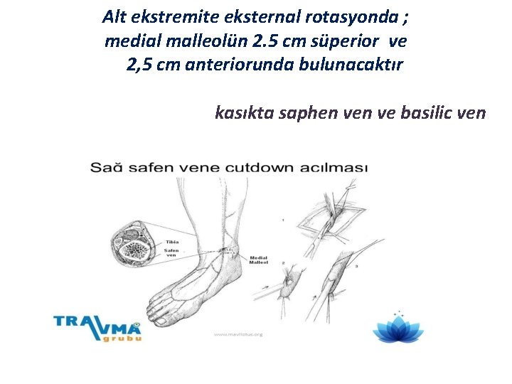Alt ekstremite eksternal rotasyonda ; medial malleolün 2. 5 cm süperior ve 2, 5