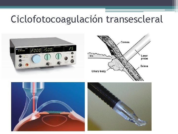 Ciclofotocoagulación transescleral 