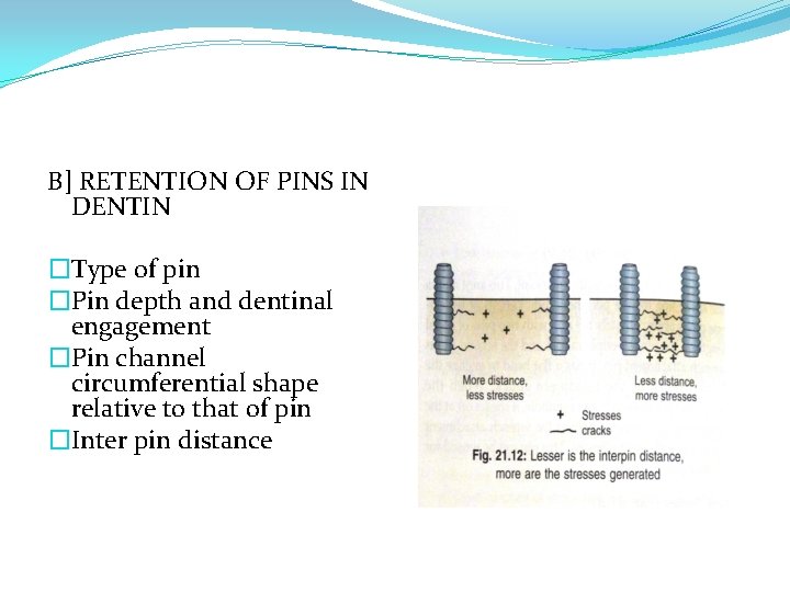 B] RETENTION OF PINS IN DENTIN �Type of pin �Pin depth and dentinal engagement
