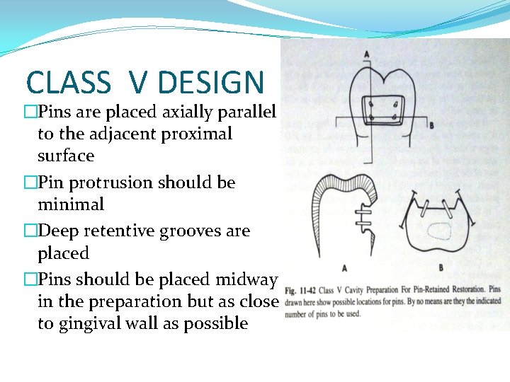CLASS V DESIGN �Pins are placed axially parallel to the adjacent proximal surface �Pin