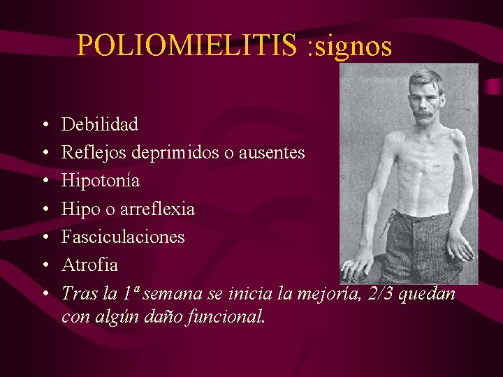 POLIOMIELITIS : signos • • Debilidad Reflejos deprimidos o ausentes Hipotonía Hipo o arreflexia