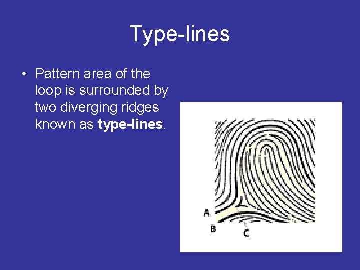 Type-lines • Pattern area of the loop is surrounded by two diverging ridges known