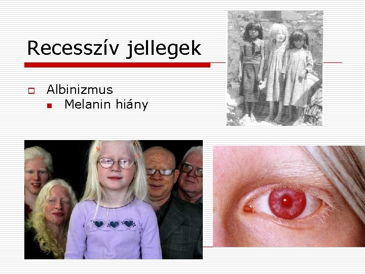 Recesszív jellegek o Albinizmus n Melanin hiány 