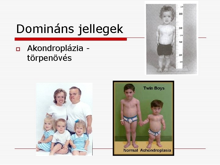 Domináns jellegek o Akondroplázia törpenövés 